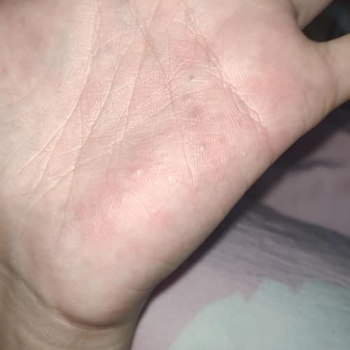 手掌上长了点东西,很痒