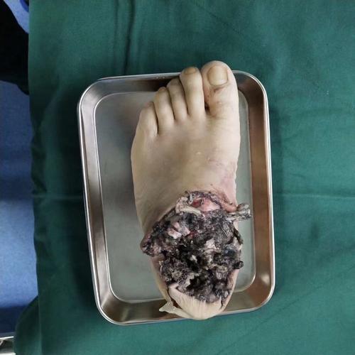 断手断脚不用怕,先施医院有专家!