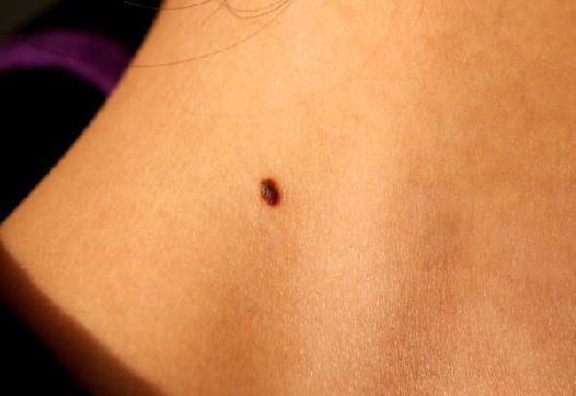 痣癌变的症状,什么样的痣最易癌变