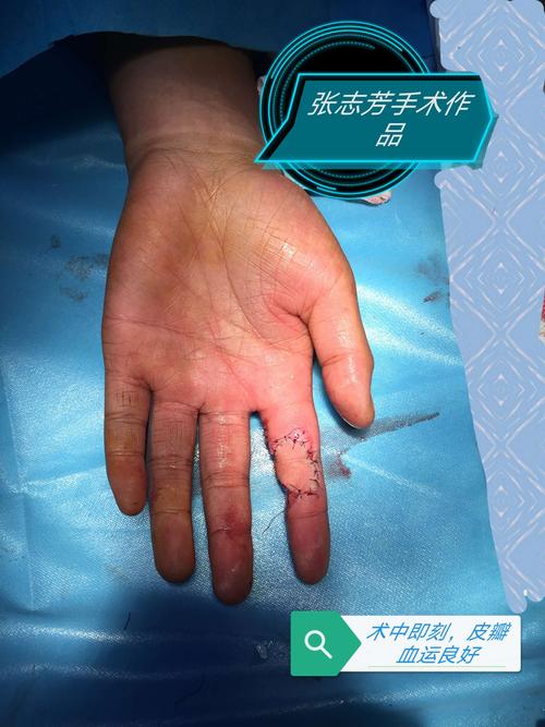 指动脉顺行皮瓣修复手指指腹缺损