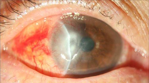 角膜炎的症状及治疗方法是什么?