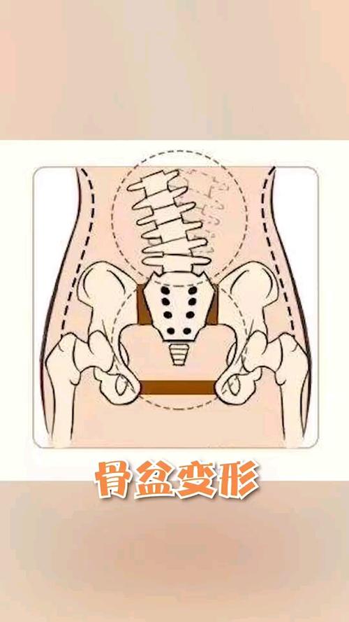 健身#真翘臀还是假翘臀?小肚子大腿粗很可能是骨盆前倾!