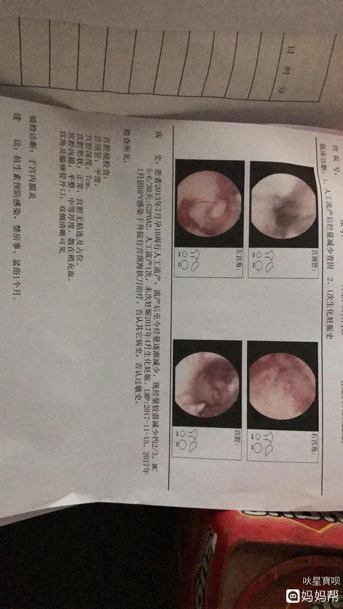 11月检查出子宫内膜炎,求治疗方法,谢谢