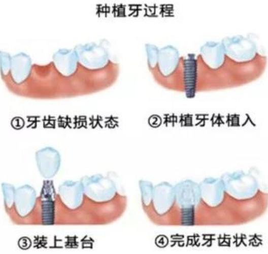 种植牙这样"种"!