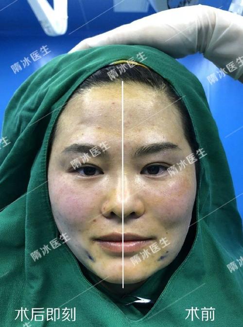 案例分享:埋线提升收紧口角囊袋!