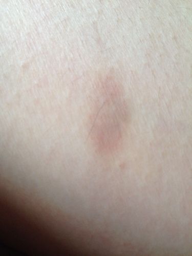 问:大腿处,刚刚发现这种斑点是怎么回事?