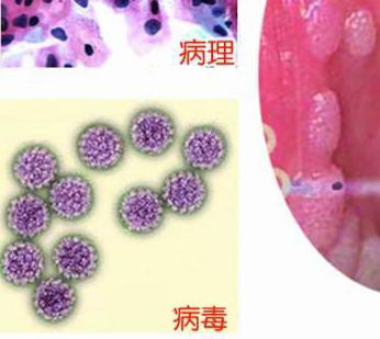 男性尖锐湿疣的长期症状有哪些