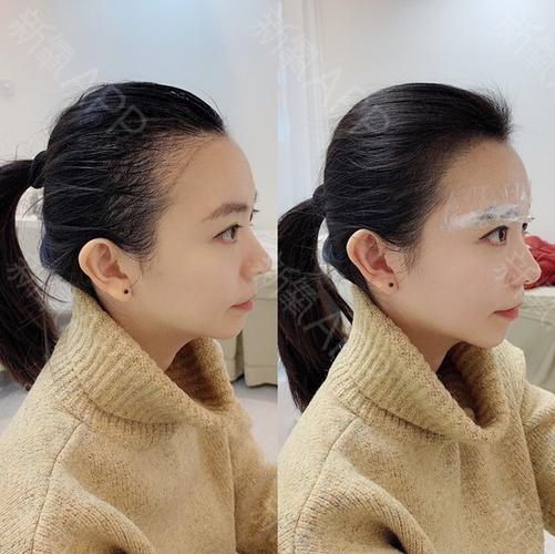 半永久纹发际线