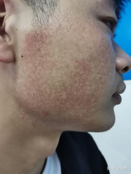 求医,毛囊角化症