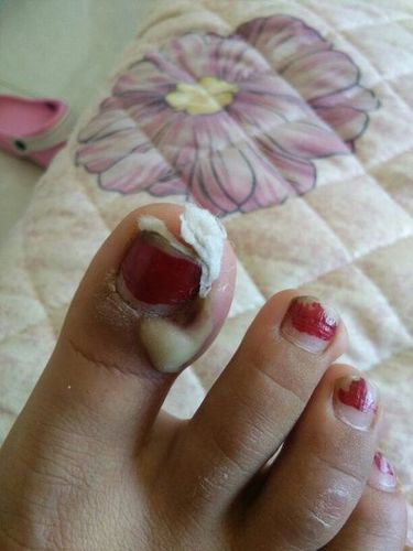 啊啊啊啊,好痛,不要活了,甲沟炎,已经恶化了(●0702`●)!