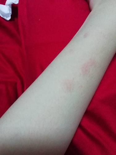 这个是什么,不痒不痛,密密麻麻的小红点,里面还有水挤