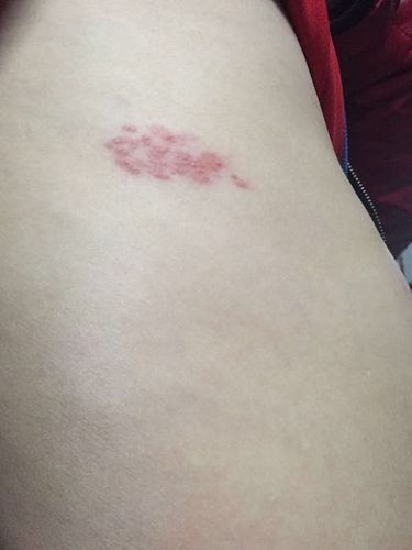 飞蛇病求治疗谁知道告诉我