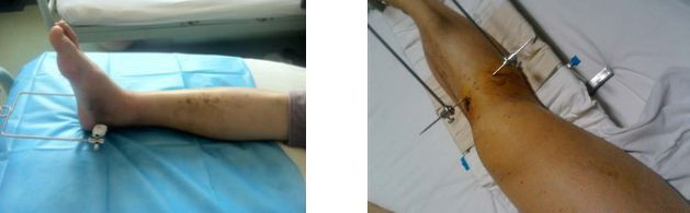 跟骨牵引(左)和胫骨结节牵引(右) 但是,目前创伤骨科手术中