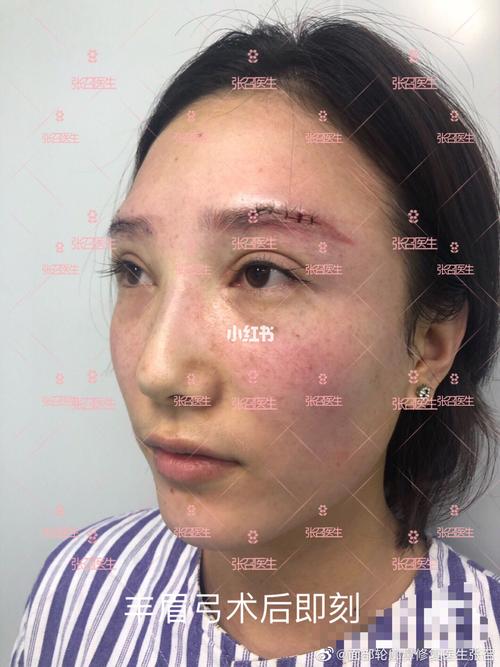 丰眉弓_膨体眉弓_美妆_医美整形
