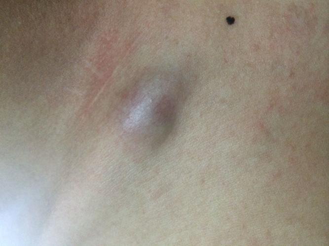 右锁骨上这个是淋巴结吗?右手动作大会有点痛(压痛)比