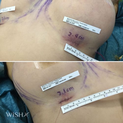 何谓2公分隆乳手术?