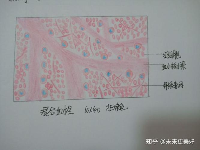 1.肾浊肿 2.混合血栓 3.化脓性阑尾炎 4.鳞状细