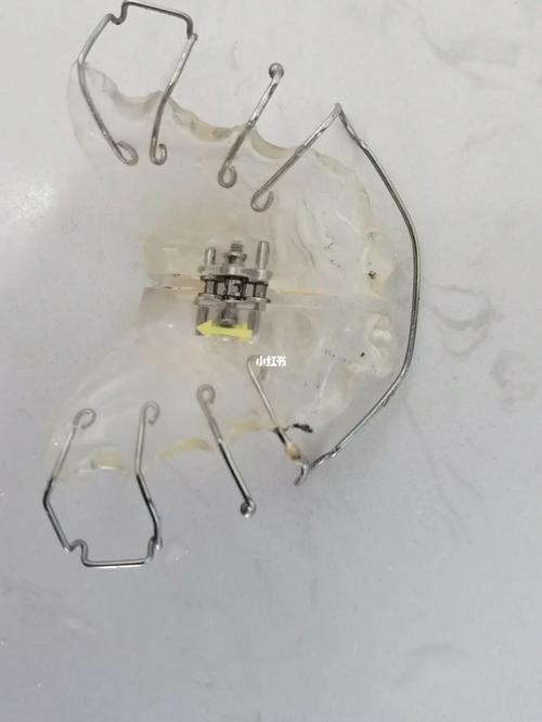 括弓器9393又称牙弓扩大螺旋器,由扩弓器,固位卡环,双曲唇弓和