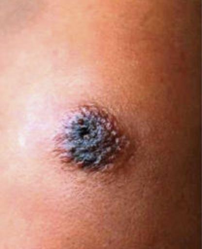 炭疽杆菌能治好吗皮肤炭疽病的症状图片炭疽病图片人图片