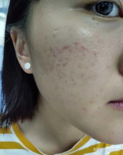 额头有很多红褐色痘印,皮肤吸收不好而且暗沉,我该怎么做,刷酸,去角质