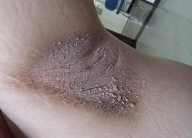 孩子,症,黑棘皮症,黑棘皮,乞丐