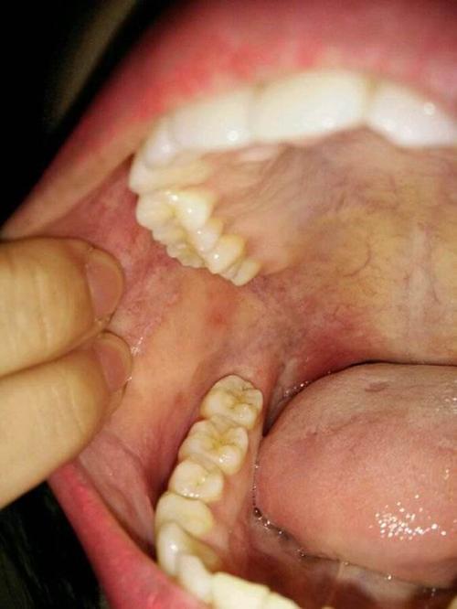 口腔扁平苔藓中医治疗有奇效