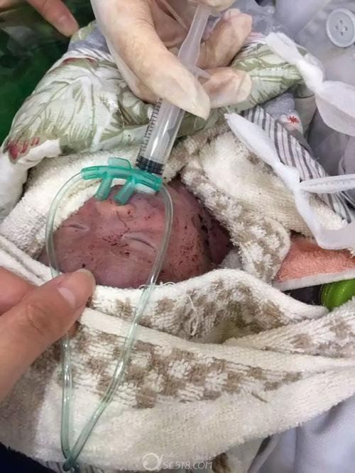 绵阳一狠心妈妈,将新生儿遗弃在水沟,发现时呼吸微弱,头上竟还有蛆卵.