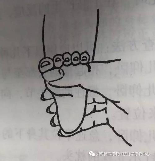 足握持的持续存在,将会影响小儿站立功能,脑瘫儿此反射可持续存在