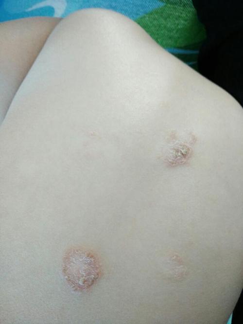 原来看医生说是湿疹不痒 现在变圆了 有经验的宝妈帮忙看看