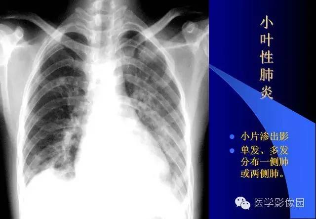 收藏|x线平片肺部常见病总结!(一)-medsci.cn