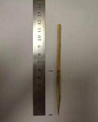 男童脸部被竹签扎进6厘米