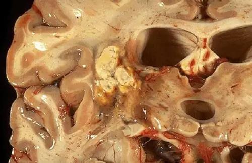 夏天爱吃烧烤,女子肚子竟藏了2公斤"肝虫"