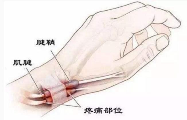 "妈妈手"是腱鞘炎的一种,又称为狭窄性腱鞘炎