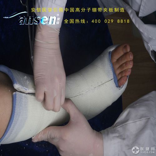 硬度高质量轻医保热销最新医用敷料高分子石膏绷带夹板