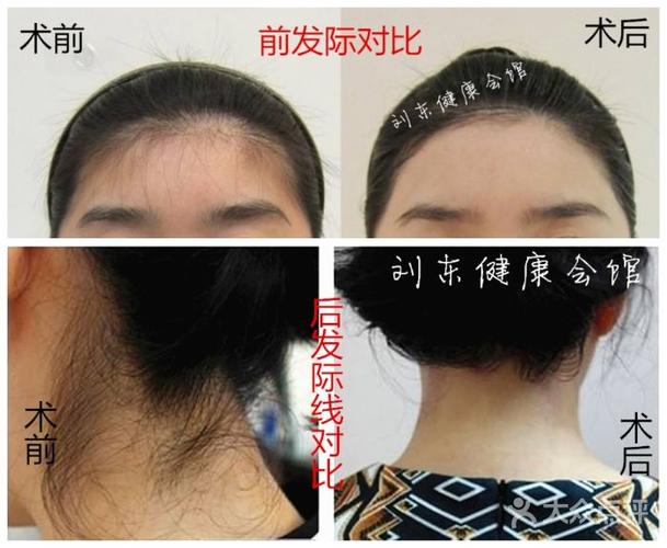 发际线对比