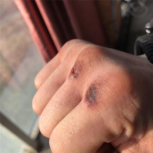 雪上加霜!离比赛还有两天,邱建良的拳头却受伤了