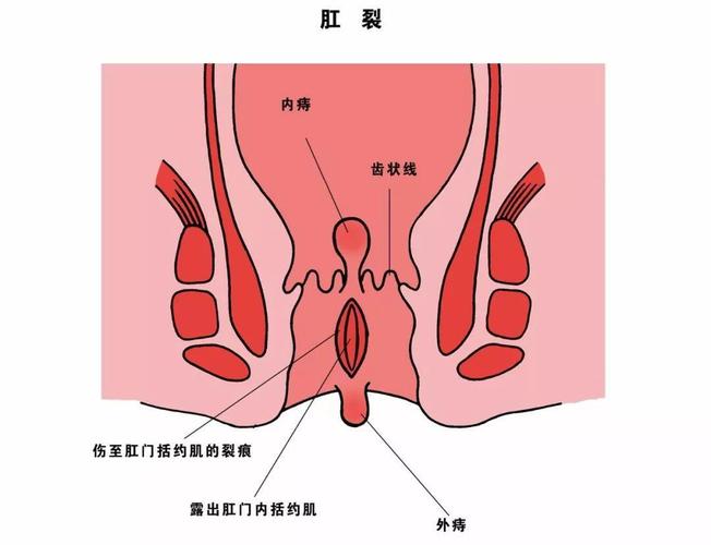 还把便血当痔疮?别傻了,当心直肠癌!