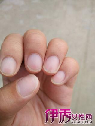 健康 正文  指甲上有白斑或云母样,表示缺钙硅等微量元素,并有寄生虫