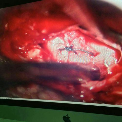 "眼界",纤维环修复在显微镜下脊柱微创手术中的视界