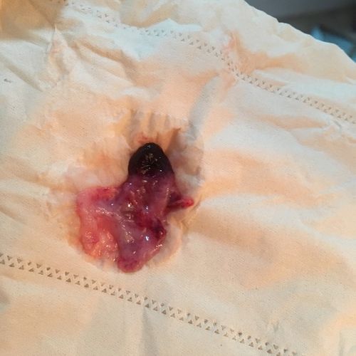 未见孕囊,流血3天,排出像白带一样的东西,请问是先兆流产还是自然生化