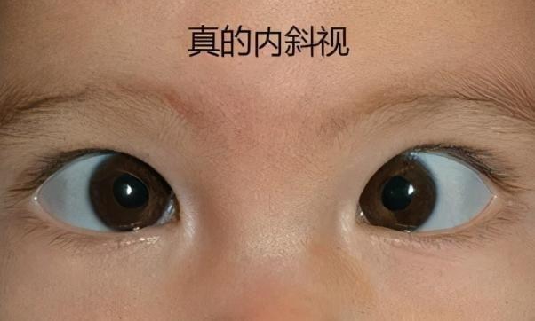 就因为妈妈的疏忽宝宝成了斗鸡眼4个生活细节要重视