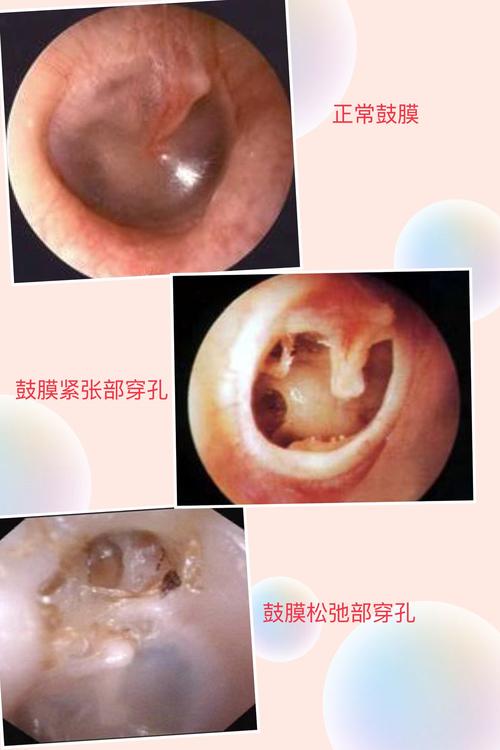 其它 听二院专家说,慢性中耳炎的手术治疗 写美篇 慢性化脓性中耳炎