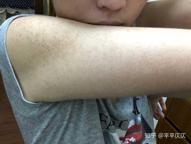 腿上胳膊上的鸡皮肤怎么消除?