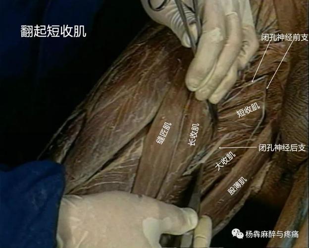 超声引导闭孔神经阻滞图解