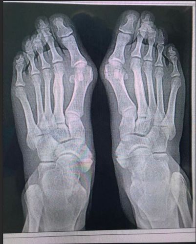 做完大脚骨多长时间走路?