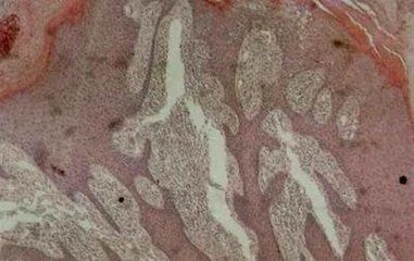 尖锐湿疣男人图片是哪些