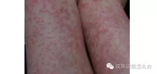 红斑,痒痒的,还有点脱皮,由于常发生在春暖花开的季节,故称之为桃花癣