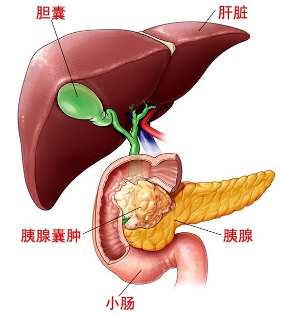 通过磁共振胰胆管成像(mrcp)的影像片子来看,陈女士的胰腺囊肿已经