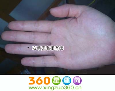右手无名指有痣右手无名指长痣图解