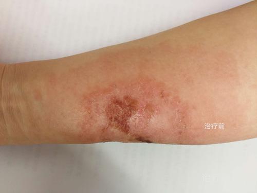 女性,45岁,职员 【主诉】 女性,45岁,职员 右上肢起红斑丘疹渗出伴痒